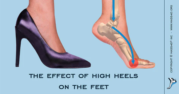 하이힐을 신은 여성의 발 구조. 하이힐을 오래 신을수록 족저근막염에 걸리기 쉽다.  